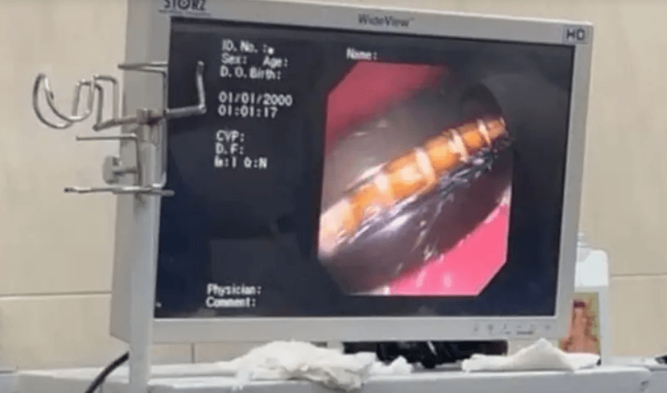 بعد 5 أشهر من المعاناة.. استخراج “محمول” من معدة مصري