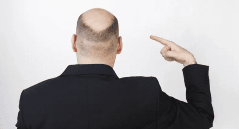 مفاجأة.. علاج جديد محتمل للصلع الوراثي