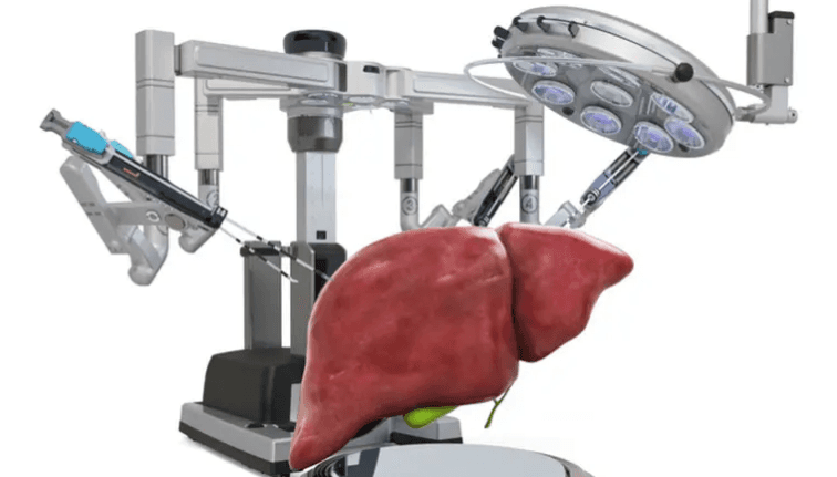 الروبوت يتفوق على البشر في جراحات الكبد!