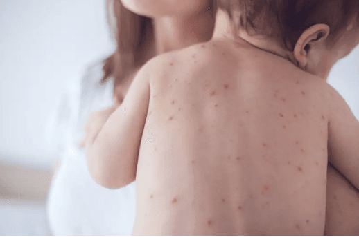 الحصبة تجتاح خُمس الولايات الأميركية