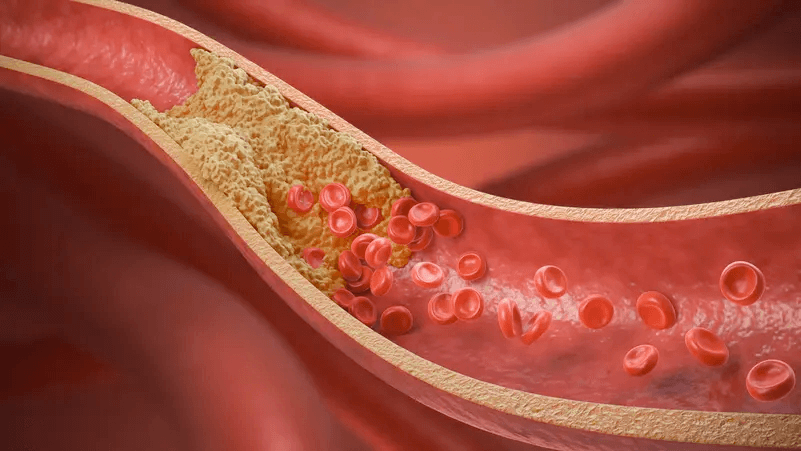 هل الأصفر تحت أظافرك علامة على ارتفاع الكوليسترول القاتل؟ لا تهملها!