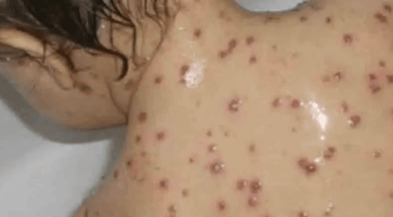 مرض يخطف أرواح أطفال المغرب.. هل من منقذ؟